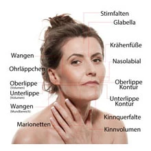 Gezicht met gelabelde behandelzones voor hyaluron