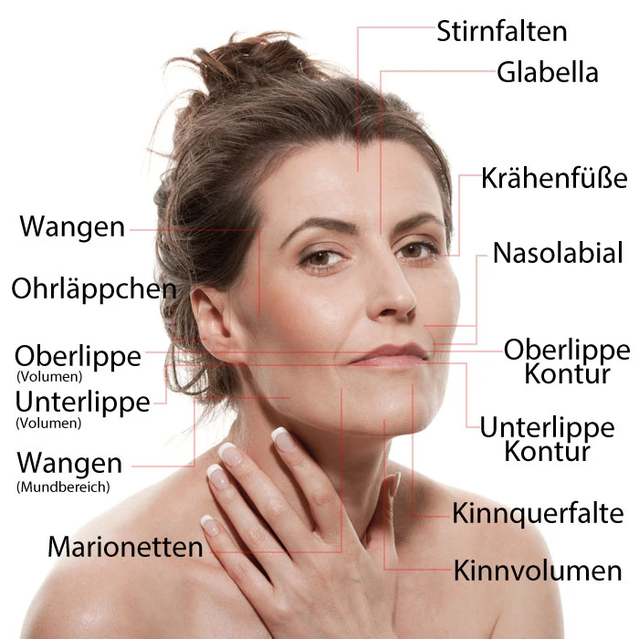 Gezichtszones met typische hyaluronhoeveelheden in milliliter