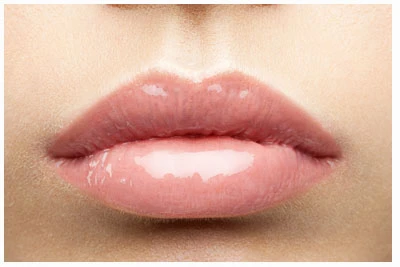 Natuurlijk volle, strak gecontoureerde lippen na een hyaluronbehandeling